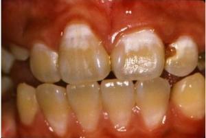 CARIE DENTAIRE: Traiter sans fraiser – Community Dentistry and Oral Epidemiology