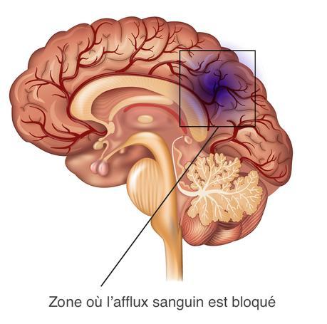 AVC - Zone où l'afflux sanguin est bloqué (schéma du cerveau)