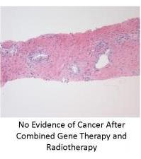 CANCER de la PROSTATE: Les promesses de la thérapie génique par gène suicide  – Journal of Radiation Oncology