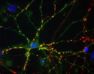 #thelancetneurology #épilepsie #cannabidiol Cannabidiol chez des patients atteints d’épilepsie résistante aux traitements : essai clinique interventionnel international ouvert