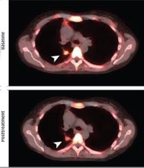 CANCERS du sein, poumon, mélanomeLe palbociclib réduit la croissance tumorale – JAMA Oncology