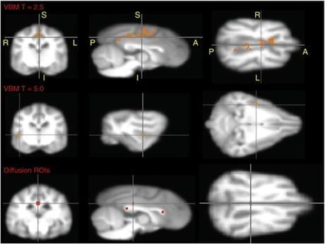 Comparaison d'IRM de cerveaux canins révélant les zones affectées chez les chiens atteints de TOC