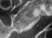 LYMPHOME associé virus d'Epstein-Barr: nouvelle immunothérapie adoptive UdeM