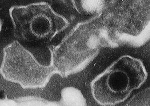 LYMPHOME associé au virus d'Epstein-Barr: Une nouvelle immunothérapie adoptive  – UdeM