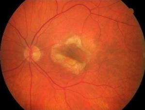 DMLA: Les promesses des statines pour rétablir l'acuité visuelle – EBioMedicine