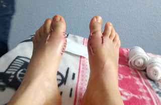 Hallux valgus bilatéral : mon expérience du désossage d'orteils.
