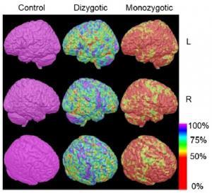 NEURO: Génétique et environnement affectent différentes zones du cerveau  – The Journal of Nuclear Medicine
