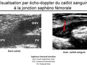 #thelancethaematology #thromboembolismeveineux #edoxaban #warfarine Durée amplifiée l’anticoagulation avec edoxaban chez patients atteints thromboembolisme analyse post-hoc d’une étude Hokusai-VTE