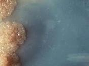 #thelancet #tuberculose #Mycobacteriumtuberculosis #ARN Signature d’expression l’ARN sanguin risque tuberculose