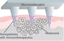 MÉLANOME: Et si l'on diffusait l'immunothérapie par patch?  – Nano Letters