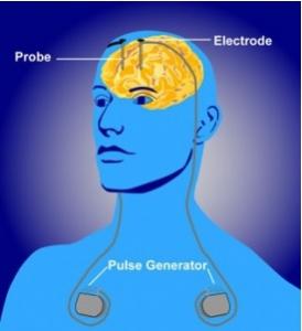 PARKINSON: Médicaments et troubles compulsifs, quelles options – Expert Review of Neurotherapeutics