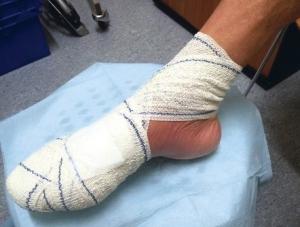 ULCÈRE du PIED DIABÉTIQUE: Pourquoi l'attitude du patient est déterminante – PLOS ONE