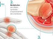 #thelancet #polyarthriterhumatoïde #TNF #rituximab #adalimumab Inhibition facteur nécrose tumeurs versus rituximab chez patients atteints polyarthrite rhumatoïde nécessitant traitement biologique (ORBIT) étude non-infériori...