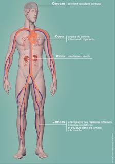 #thelancet #événementscardiovasculaires #excrétionurinairedesodium Association entre excrétion urinaire de sodium et évènements cardiovasculaires chez des sujets avec ou sans hypertension : analyse de données mutualisées issues de quatre études