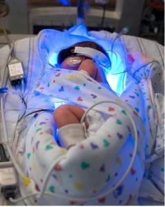 ICTÈRE du nouveau-né: La photothérapie accroît-elle le risque de cancer pédiatrique? – Pediatrics