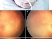 ZIKA microcéphalie: virus s'attaque aussi yeux bébés Ophtalmology