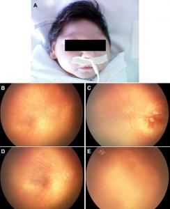 ZIKA et microcéphalie: Le virus s'attaque aussi aux yeux des bébés – Ophtalmology