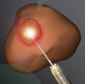 CANCER de la PROSTATE, continence et sexualité: L'ablation laser, le meilleur traitement? – Journal of Urology