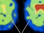 PARKINSON: NAC, vitamine booste dopamine PLoS