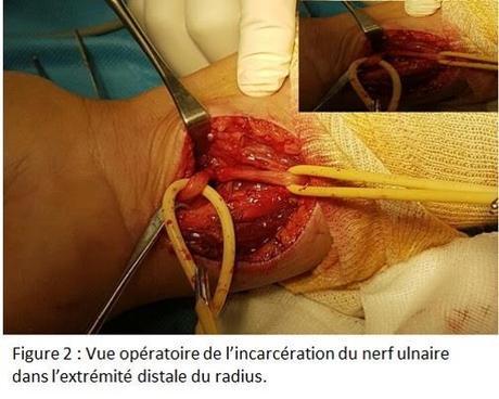 Incarcération du nerf ulnaire en intra-osseux suite à un brochage pour  fracture de l’extrémité distale du radius