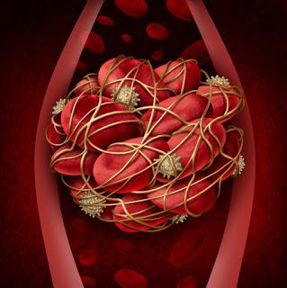 #thelancethaematology #thromboemolieveineuse #edoxaban #cancer Edoxaban pour le traitement de la thrombo-embolie chez des patients atteints de cancer : résultats d’une analyse de non-infériorité sur un sous-groupe de l’essai  Hokusai-VTE randomisé, en ...