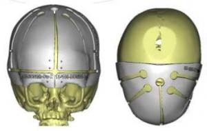 CHIRURGIE MAXILLO-FACIALE: L'imprimante 3D pour une reconstruction tout en finesse – CHU Réseau