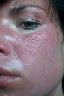 Tori Spelling hospitalisée : Gravement brûlée, elle subit une greffe de peau