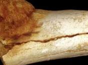 CANCER: ostéosarcome vieux million d'années South African Journal Science