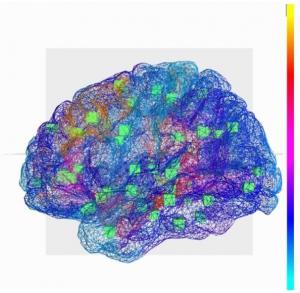 ÉPILEPSIE: Un cerveau virtuel qui reconstitue les crises du patient – NeuroImage