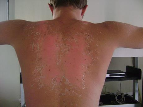 Hydrater sa peau  Hydratation après le bronzage  Doctissimo