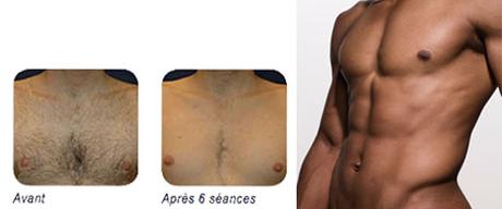 Laser Esthetique Bordeaux Bel Air : Epilation Laser