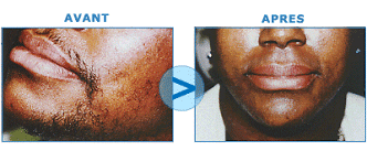 épilation laser sur peau bronzée  Epilation Definitive Laser Paris