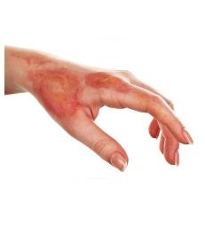 BRÛLURE: Une nouvelle technologie pour prévenir les cicatrices ?  – Journal of Investigative Dermatology