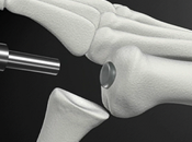 ARTHROSE: Premier implant cartilage synthétique approuvé Santé Orthopédique