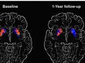 PARKINSON: biomarqueur non-invasif évident l'efficacité traitement? Neurology