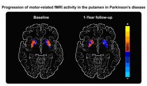 PARKINSON: Un biomarqueur non-invasif évident de l'efficacité du traitement? – Neurology