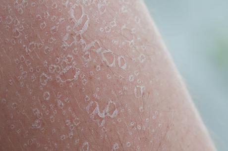 Que faire sur une peau qui pèle ?  Bronzage, soleil et UV  FORUM Beauté