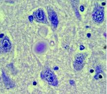 PARKINSON: Grande avancée vers un test de diagnostic précoce – Annals of Clinical and Translational Neurology