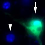 PARKINSON: Le virus cérébral qui fait passer la maladie – Science