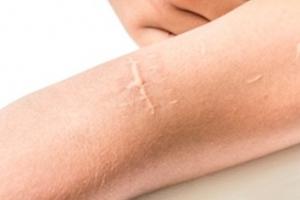 CICATRICE CHÉLOÏDE: Le composé révolutionnaire qui élimine la cicatrice – ACS