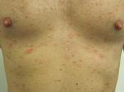 bronzage peau gratte