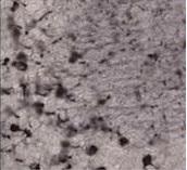 TAUOPATHIES: A chaque type d'agrégat, son type de démence? – Neuron