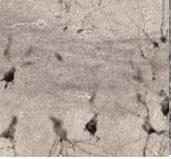 TAUOPATHIES: A chaque type d'agrégat, son type de démence? – Neuron