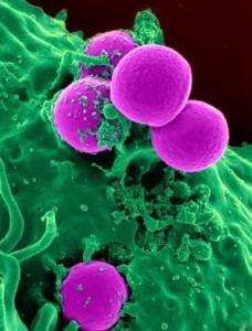 ULCÈRE du PIED DIABÉTIQUE: La particule d'ADN qui bloque la surinfection – Inserm et Journal of Infectious diseases