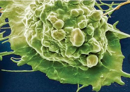 CANCER de la VESSIE : L'acide aminé qui rend accros 90 % des carcinomes  – American Journal of Pathology