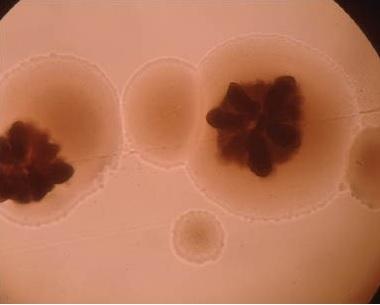 PARODONTITE : Et si elle entraînait la polyarthrite rhumatoïde ? – Science Translational Medicine