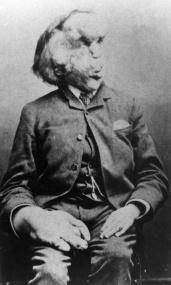 Joseph Merrick – Il est vrai que mon apparence est étrange…