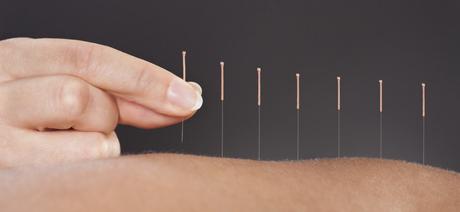intro-acupuncture