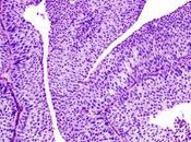 #thelancetoncology #cancerurothélial #pembrolizumab Sécurité activité pembrolizumab chez patients atteints cancer urothélial avancé métastatique (KEYNOTE-012) étude phase randomisée ouverte