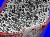 OBÉSITÉ l'adolescence risque perte osseuse RSNA 2016
